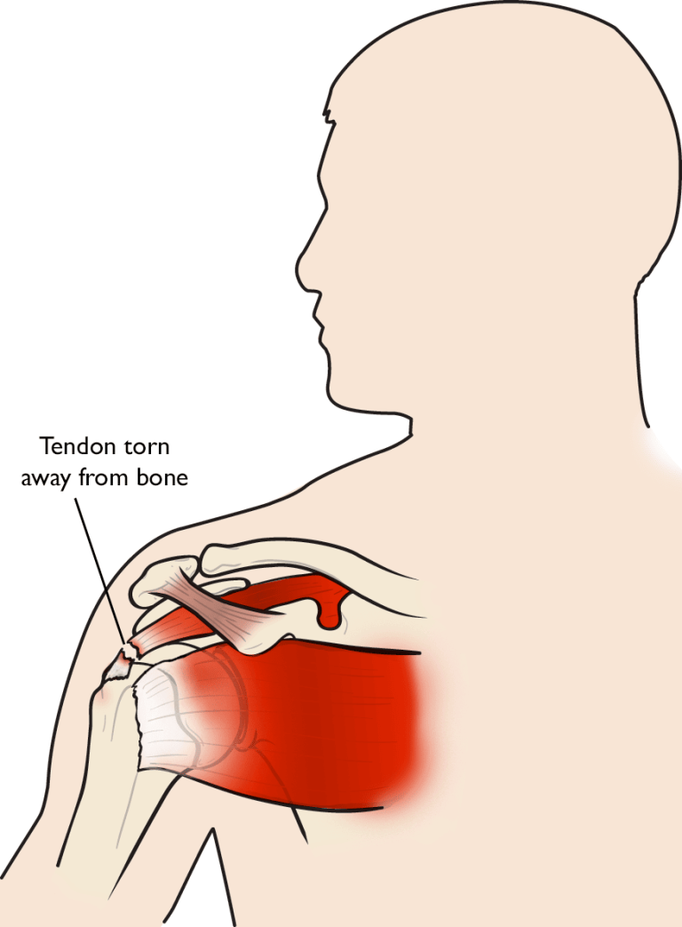 ﻿New Help for Rotator Cuff Injuries